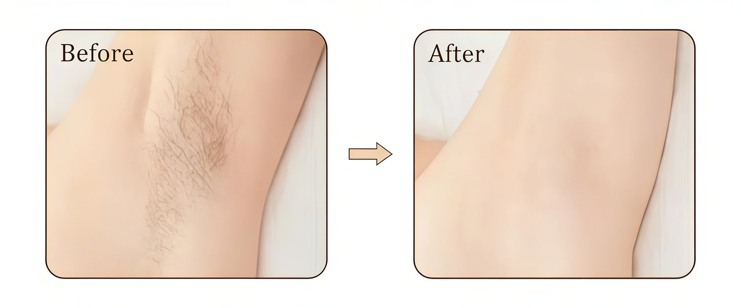 Painless IPL Hair Remover – Ice Cooling System with Replaceable Heads